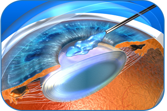 Déroulement de la chirurgie de la cataracte