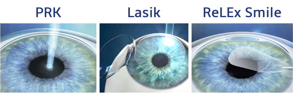 les différents traitements laser lasik PKR SMILE pour corriger sa vision