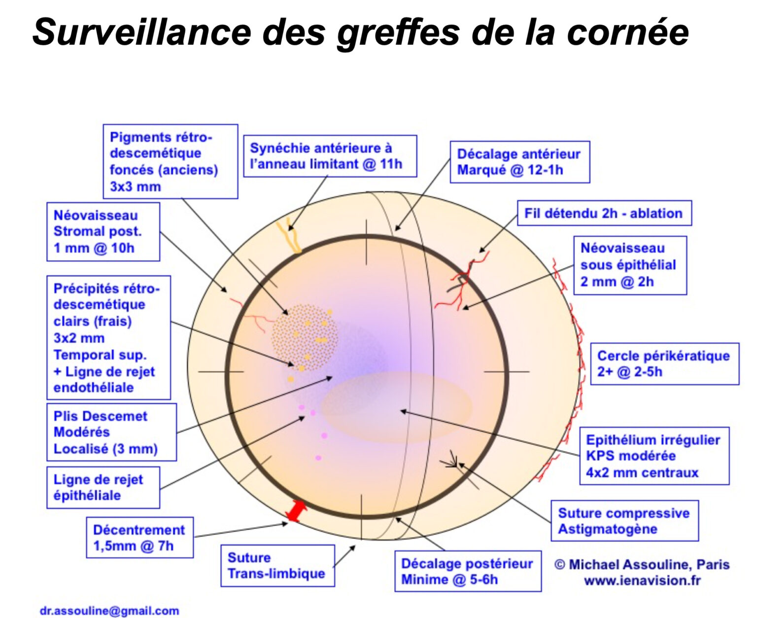 Greffe de cornée : traitements chirurgicaux du kératocone